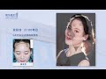 女性髮際線種植lattice點陣加密植髮 2100單位效果分享yonghe hair transplant