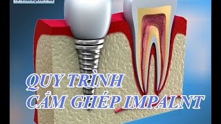 Quy trình cấy ghép implant nha khoa Đại Việt