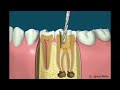 عصب کشی دندان چیست چگونه انجام می شود؟