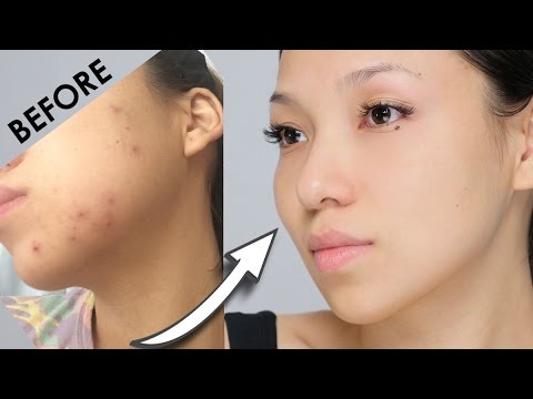 Remove Acne Marks | 3 Home Remedies (100% Works) With Results Remove Acne Marks | 3 Home Remedies (100% Works) With Results