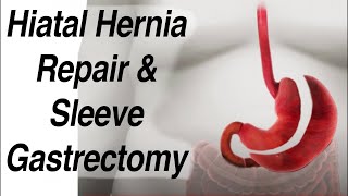 Hiatal Hernia Repair \u0026 Sleeve Gastrectomy Weight Loss Surgery Animation