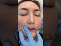 Lips Filler Treatment by Ami - Ageless MD