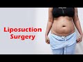 360° Abdomen Liposuction | Liposuction in Delhi @dezireclinic