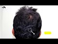 hair transplant in davanagere best doctor clinic cost u0026 results of hair transplant in davanagere