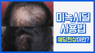 탈모방지약 미녹시딜의 사용법과 효과 | 부작용, 쉐딩현상 알고 사용하기