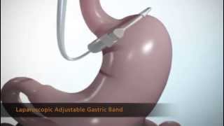 Laparoscopic Adjustable Gastric Band