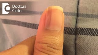 What causes vertical black lines on fingernails? - Dr. Aruna Prasad
