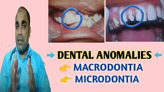 दॉतों का अनियमित आकार क्यों होता है| दॉत के बड़े आकार का कारण और इलाज | Dental anomalies|Macrodontia