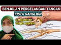 APAKAH KISTA GANGLION BERBAHAYA -  PENGOBATAN GANGLION  SELAIN OPERASI