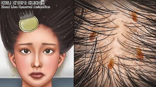 ASMR 소름주의! 근질근질 머릿니 속 시원하게 제거하기 | 지루성 피부염 치료 | Get rid of tons of head lice