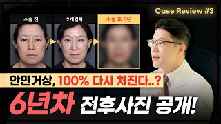 안면거상 어차피 다시 처진다던데..? 😡 6년차 전후사진 공개합니다 [안면거상술 후기 3]