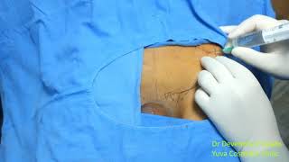 Iliohypogastric \u0026 Ilioinguinal Nerve Block