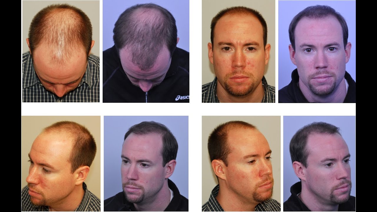 BEFORE & AFTER Hair Transplant: 6 MONTHS AFTER - YouTube