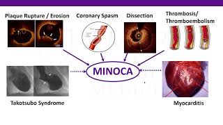 Multi-Modality Imaging in Myocardial Infarction with Non-Obstructive CAD (MINOCA)
