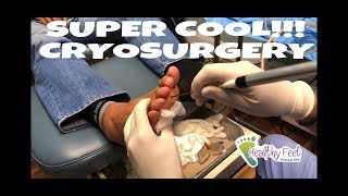 Cryosurgery for Neuromas: Minimally Invasive Neuroma Surgery.