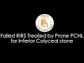 Failed RIRS Treated by Prone PCNL for Inferior Calyceal stone