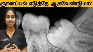 ஞானப்பல் எப்போது அகற்ற வேண்டும் /wisdom tooth removal when to do and when not to do.