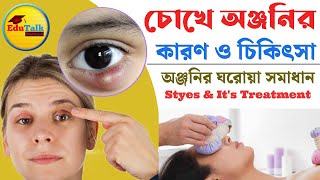 চোখে অঞ্জনি হলে করণীয় | অঞ্জনির ঘরোয়া চিকিৎসা | অঞ্জনি কেনো হয় চোখের পাতায় | How to get rid of Stye