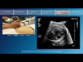 Key screening views of the fetal heart - Part 5 - Right ventricular outflow