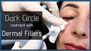 Restylane® Injection for Under Eyes | Atlanta Fillers \u0026 Injectables | Y Plastic Surgery