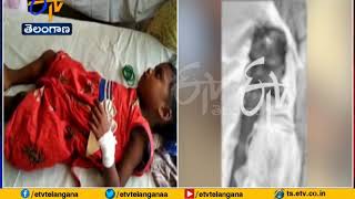 Girl Dies | After Mulugu MLA Seethakka Vehicle Hits Bike | at Eturu Nagaram