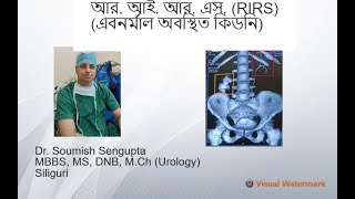 আর. আই. আর. এস. (RIRS)-- Ectopic Malrotated kidney Stone--এবনর্মাল অবস্থিত কিডনিতে পাথর।