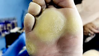 The Soles Of My Feet Are Covered With Thick Calluses, Which Are Super Big【Pedicure Master Lin Jun】