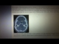 craniopharingiomas x ray n ct features