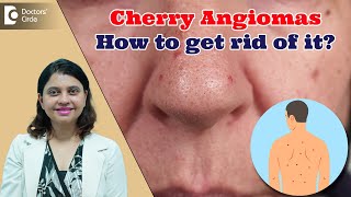 RED DOTS ON SKIN | Cherry Angioma & its Treatment | Red Moles - Dr. Amee Daxini