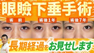 【長期経過】眼瞼下垂手術の術後7年の患者様の状態を紹介します！