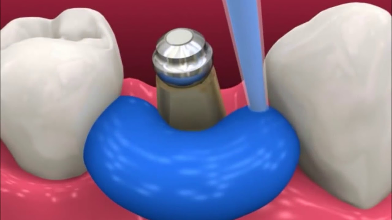 Dental Implant Youtube