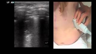 Point-of-Care Ultrasonography for Diagnosis of Pneumonia in Children and Young Adults