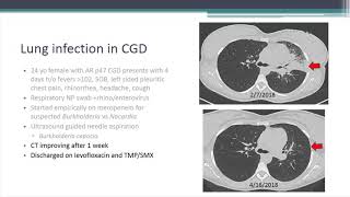 Lung Inflammation/Granuloma Problems with CGD