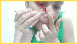 अब कील मुंहासों का अंत होगा तुरंत | Pimples Kaise Hote hai Aur Theek Karne ke Tarike in Hindi