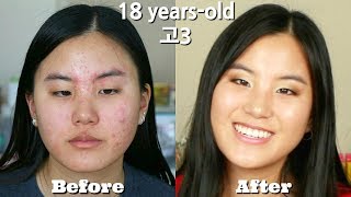 여드름 없애는 제품과 셀리턴 LED 마스크 - How I Cleared My Acne Skin