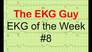 EKG/ECG of the Week #8 | The EKG Guy - www.ekg.md