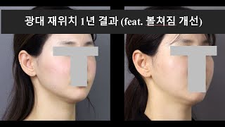 광대재위치 1년결과  feat. (볼쳐짐 개선) 1-year result of malar repositioning (feat. Improvement of cheek sagging)