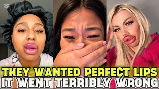 Lip Fillers Ruined my Life - Women Are Dissolving the Lips They Paid For