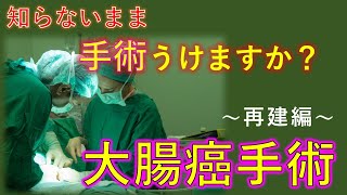 これだけは知っておきたい、S状結腸切除の吻合【医師解説】2022