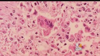 Case Of Measles Confirmed At Lowell Community Health Center
