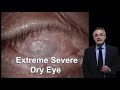 Surgical Treatment for Severe Dry Eye - José Alvaro P. Gomes, MD PhD