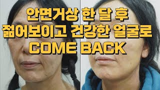 안면거상 한 달 후 젊어보이고 건강한 얼굴로 COME BACK