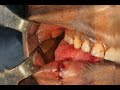 Supraclavicular flap for buccal mucosa reconstruction. - Dr Kanishk Vishnoi