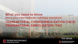 TACE and TAE: transarterial chemoembolization/transarterial embolization | Ohio State Medical Center