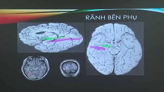 HÌNH ẢNH CT-MRI SỌ NÃO BÌNH THƯỜNG VÀ CÁC BIẾN THỂ | Bs. CK2. Cao Thiên Tượng