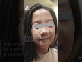 filipina teen receives major facial reconstruction surgery in scotland