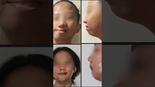 Filipina teen receives major facial reconstruction surgery in Scotland