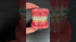 Best Summer Braces Colors Combos