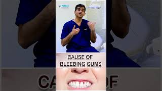 CAUSES OF BLEEDING GUMS | Pearls Dentistry..-Dr.Arunkumar