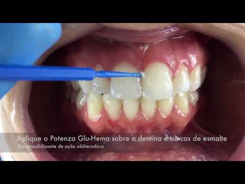 Protocolo De Hipersensibilidade Dentinária Associado Ao Clareamento ...